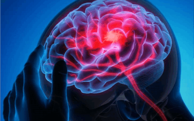 Apneia do Sono e AVC