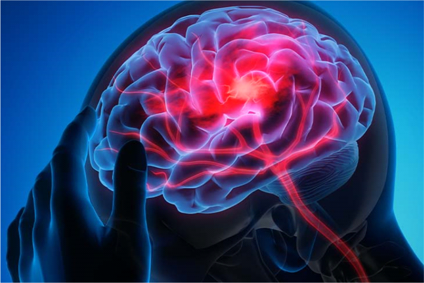 Apneia do Sono e AVC